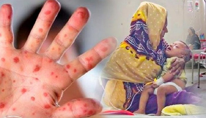 দেশে একদিনে হাম উপসর্গে ৪ শিশুর মৃত্যু