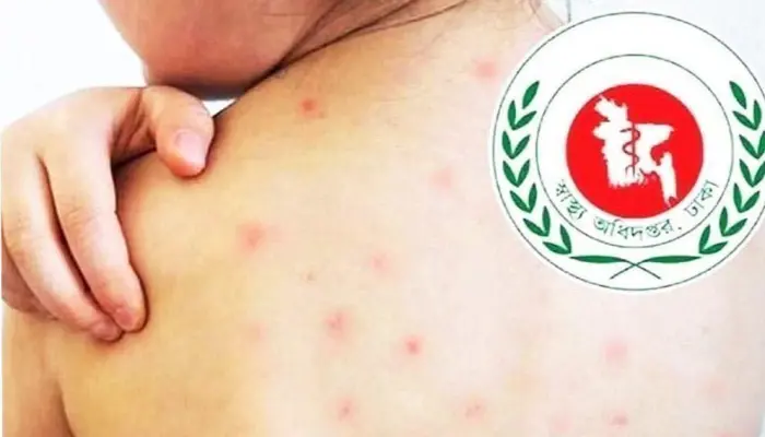 দেশে হামের উপসর্গ নিয়ে আরও ৬ জনের মৃত্যু